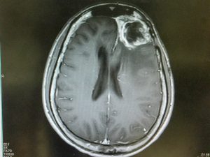 Glioblastoma Brain Scan